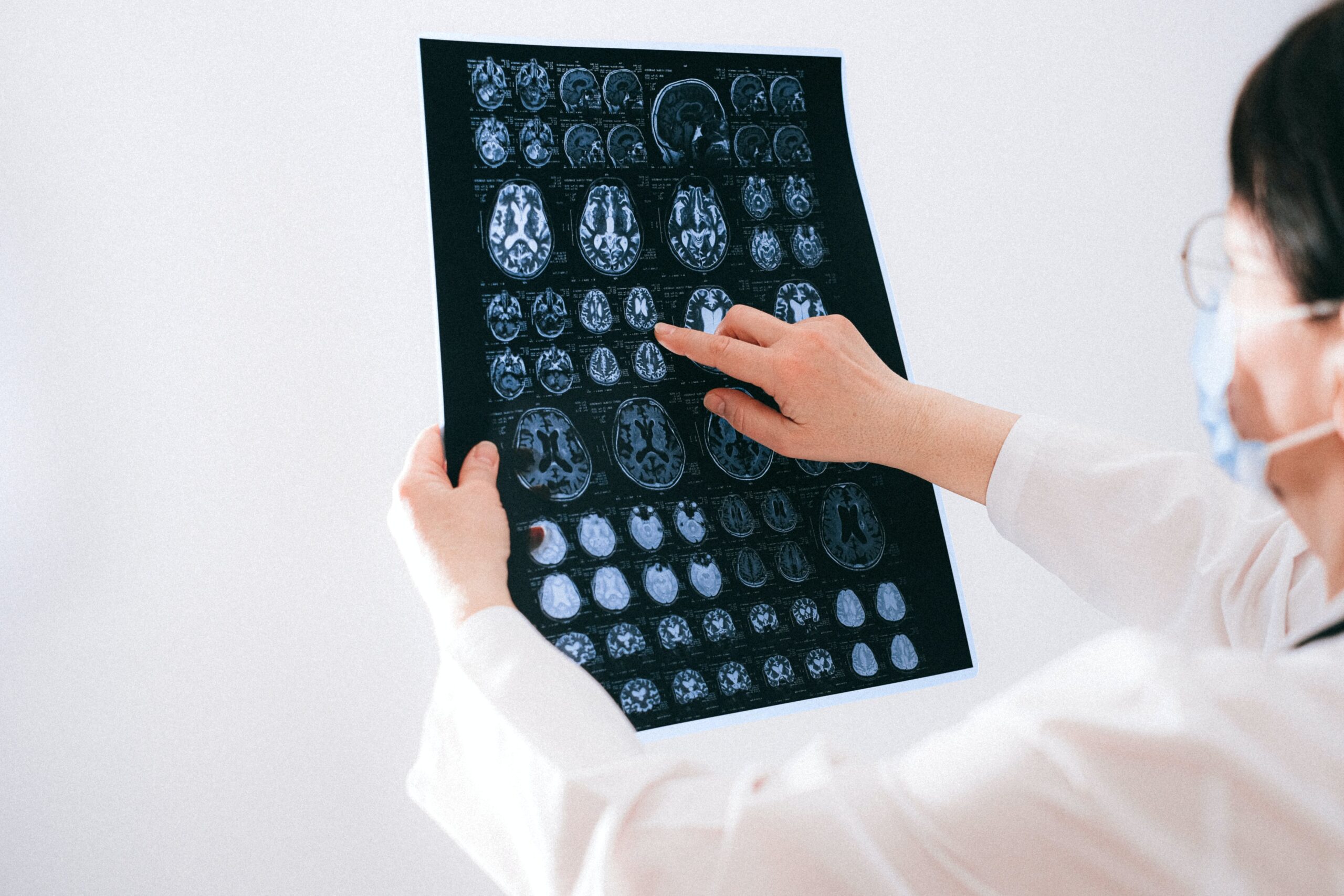 Más allá del diagnóstico: la epilepsia y las barreras que persisten