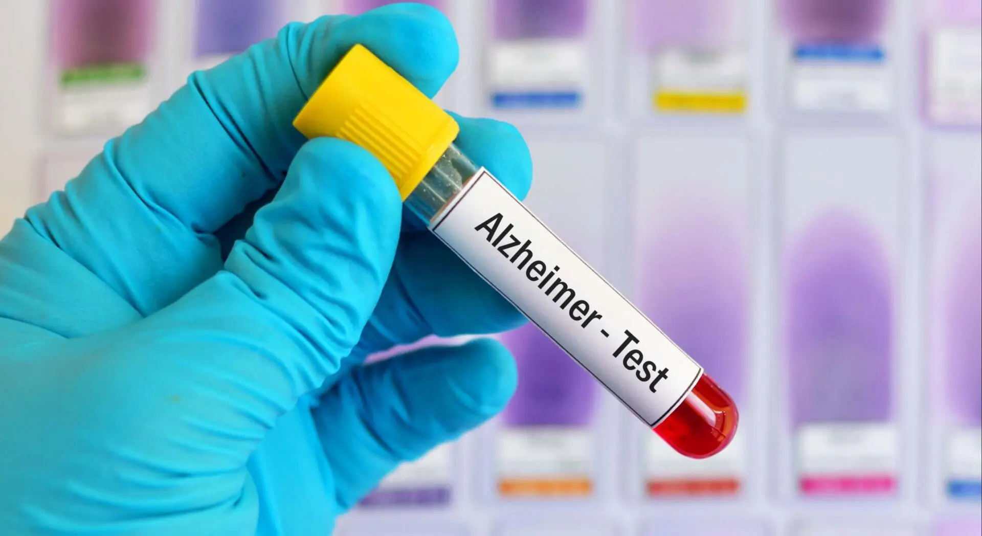 Revolucionario análisis de sangre podría rastrear progresión del Alzheimer